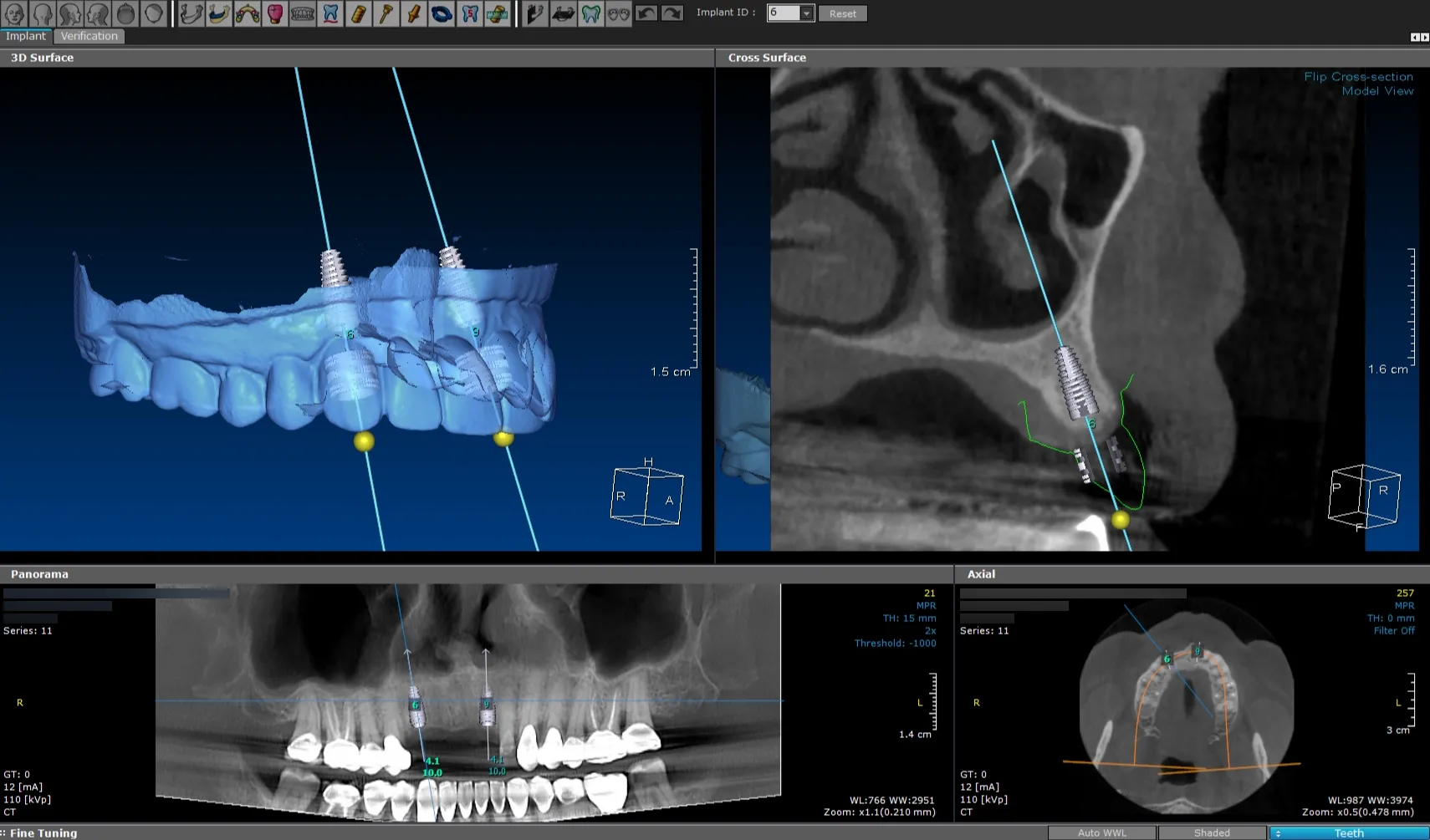 Nex-Gen Surgical Guides