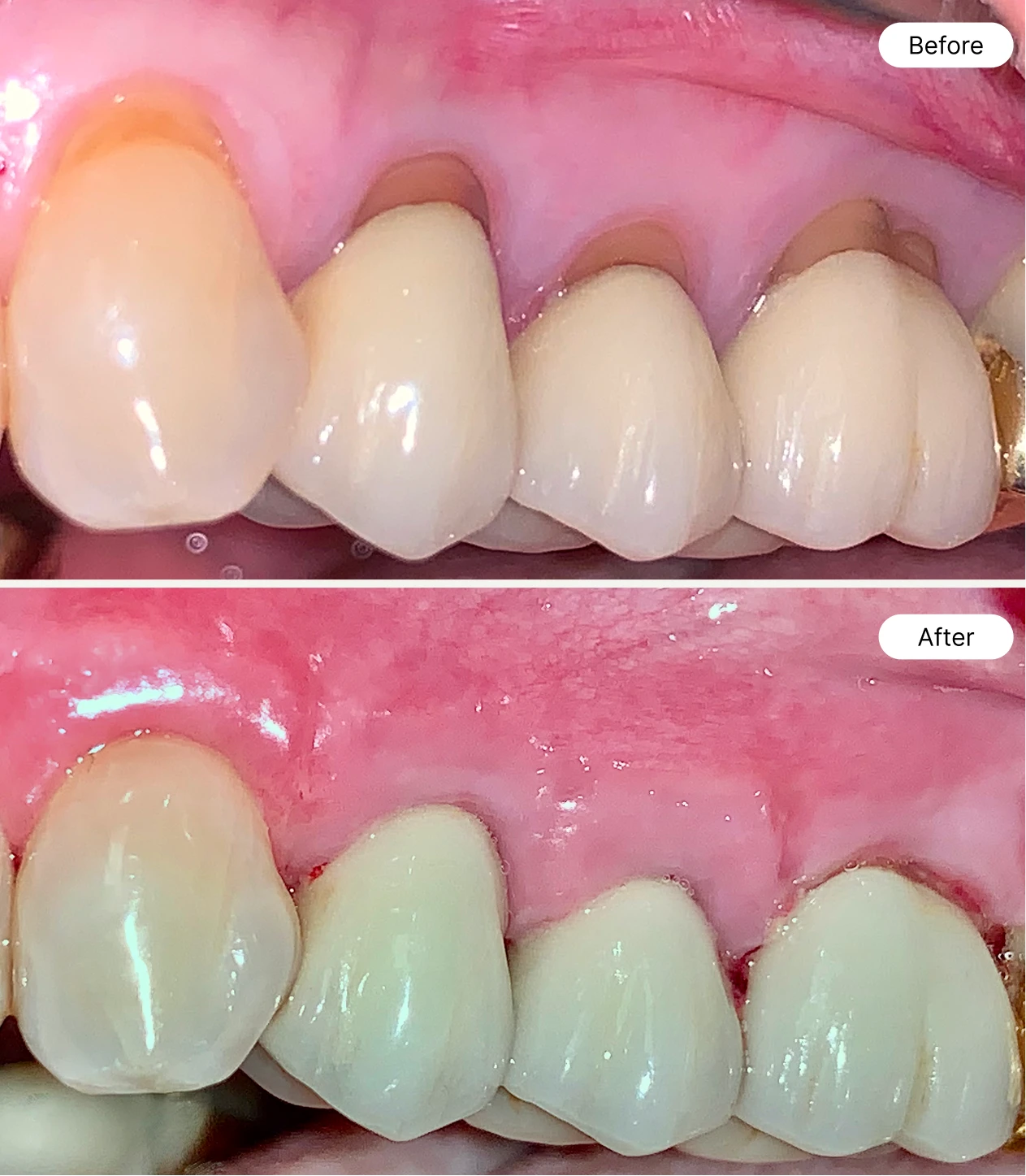 life oral health before and after case 1
