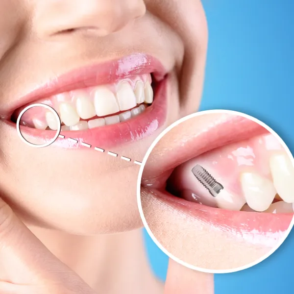 Natural-Looking Teeth dental implants
