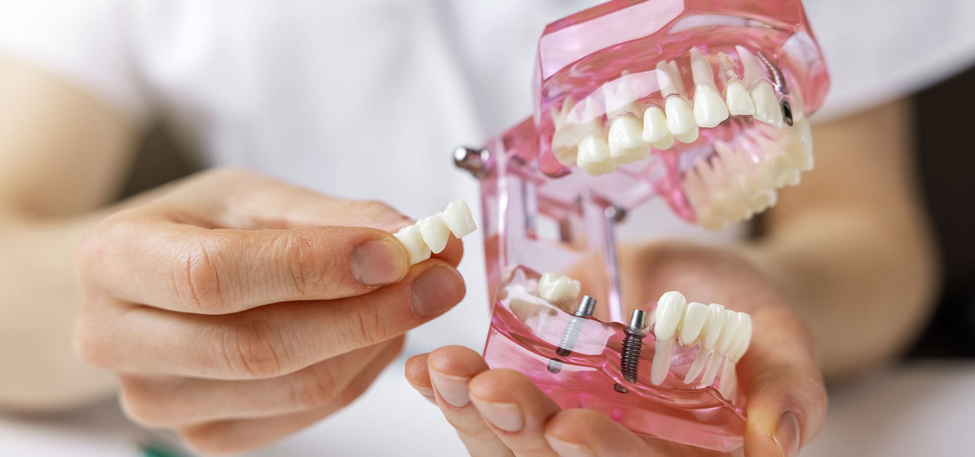 Dental Bridge vs. Implant: Which Is Better?