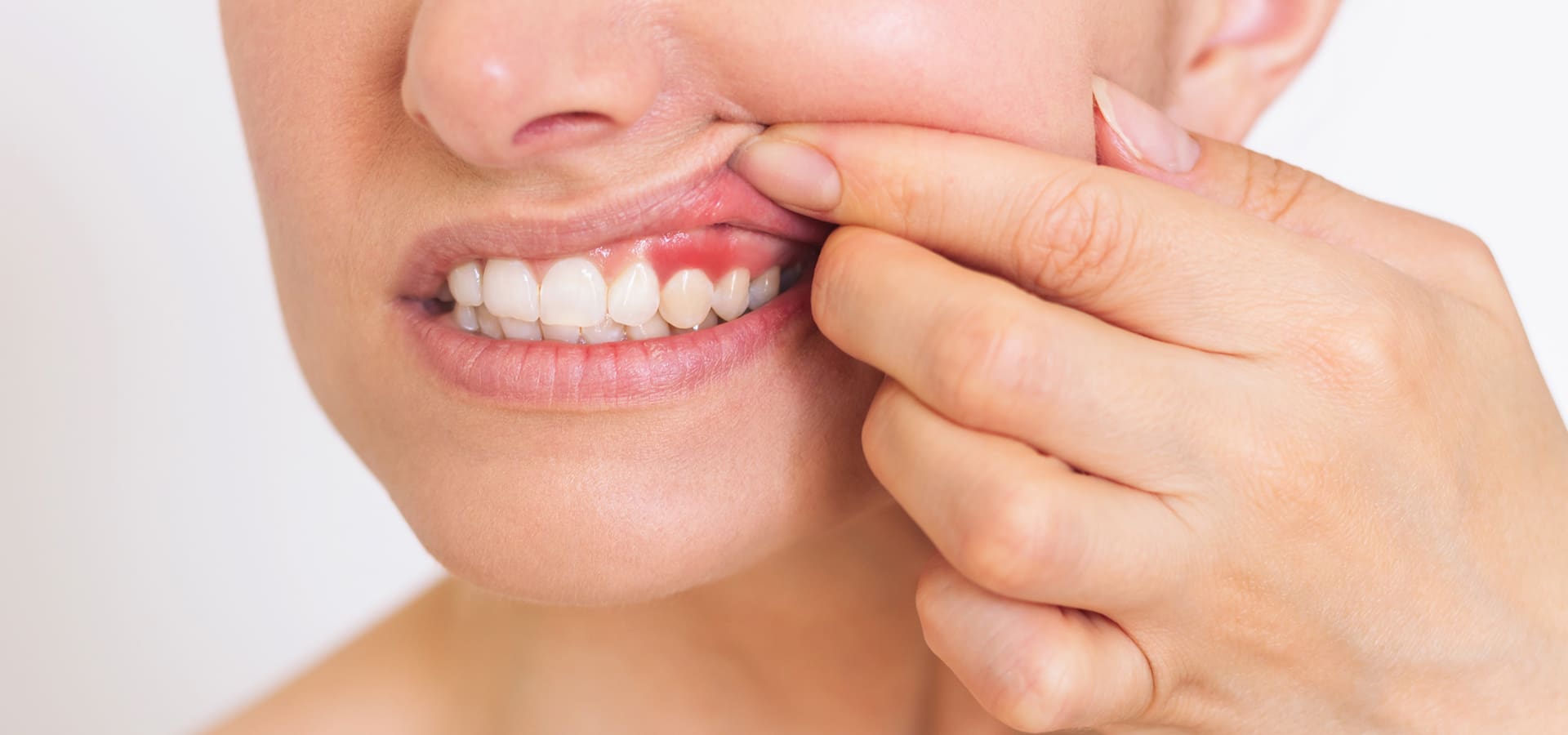 Gingivitis vs. Periodontitis: What Is the Difference?